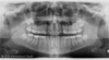 Gendex GENDEX GXDP-700 Panorex Ceph Cone Beam