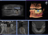 SIRONA ORTHOPHOS XG 3D Panorex Ceph Cone Beam