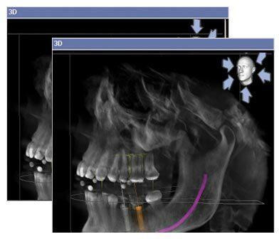 Sirona Galileos Comfort Cone Beam Sirona CBCT Renew Digital