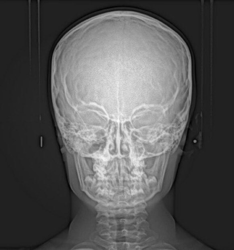 Ray購入9300 S Carestream CS 9300 Premium Panorex + Cone Beam For Sale
