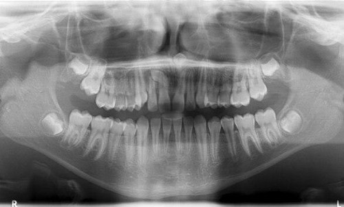 Ray購入9300 S Carestream CS 9300 Premium Panorex + Cone Beam For Sale