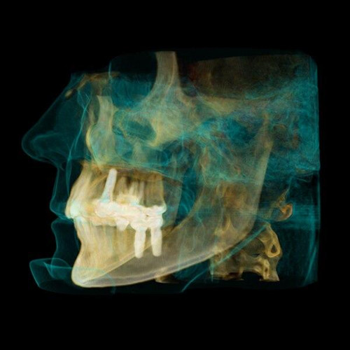 Ray購入9300 S Carestream CS 9300 Premium Panorex + Cone Beam For Sale