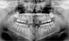 Capture high quality pediatric panoramic dental X-ray images with Kodak 8000 while reducing dose by up to 40%.