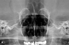 Kodak 8000 dental digital X-ray system delivers clear maxillary sinus views for easy diagnosis.
