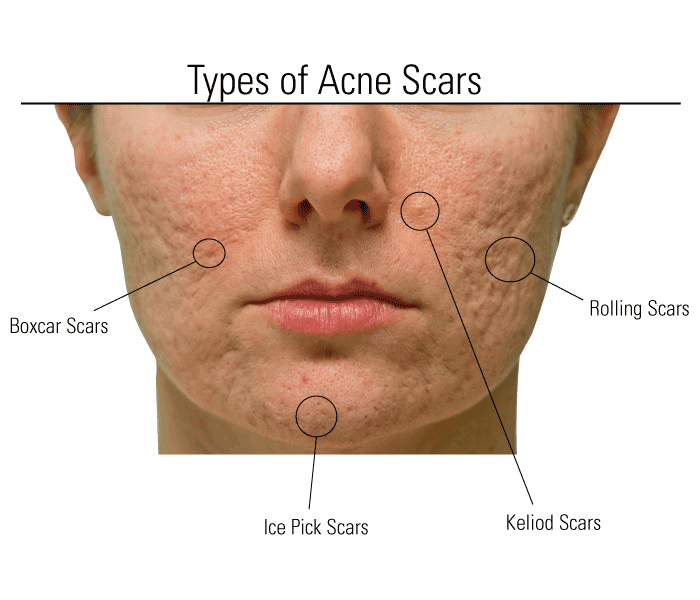 rolling acne scars