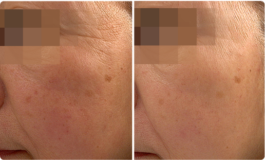 Before/After using Facial Treatment Essence