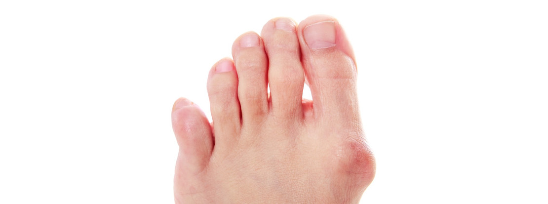 How You Can Fight Bunion Pain (Even While You Sleep) How You Can Fight Bunion Pain (Even While You Sleep)