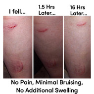 TESTIMONIAL: Wound Healing [I Fell & Hurt My Leg]