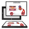 MINI98100 Atherosclerosis, Framed UV Poster Board