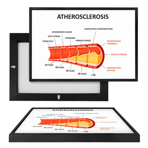 MINI98103 Atherosclerosis, Framed UV Poster Board