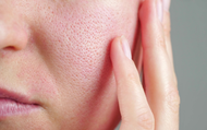 Feel like yourself again - finding relief from eczema