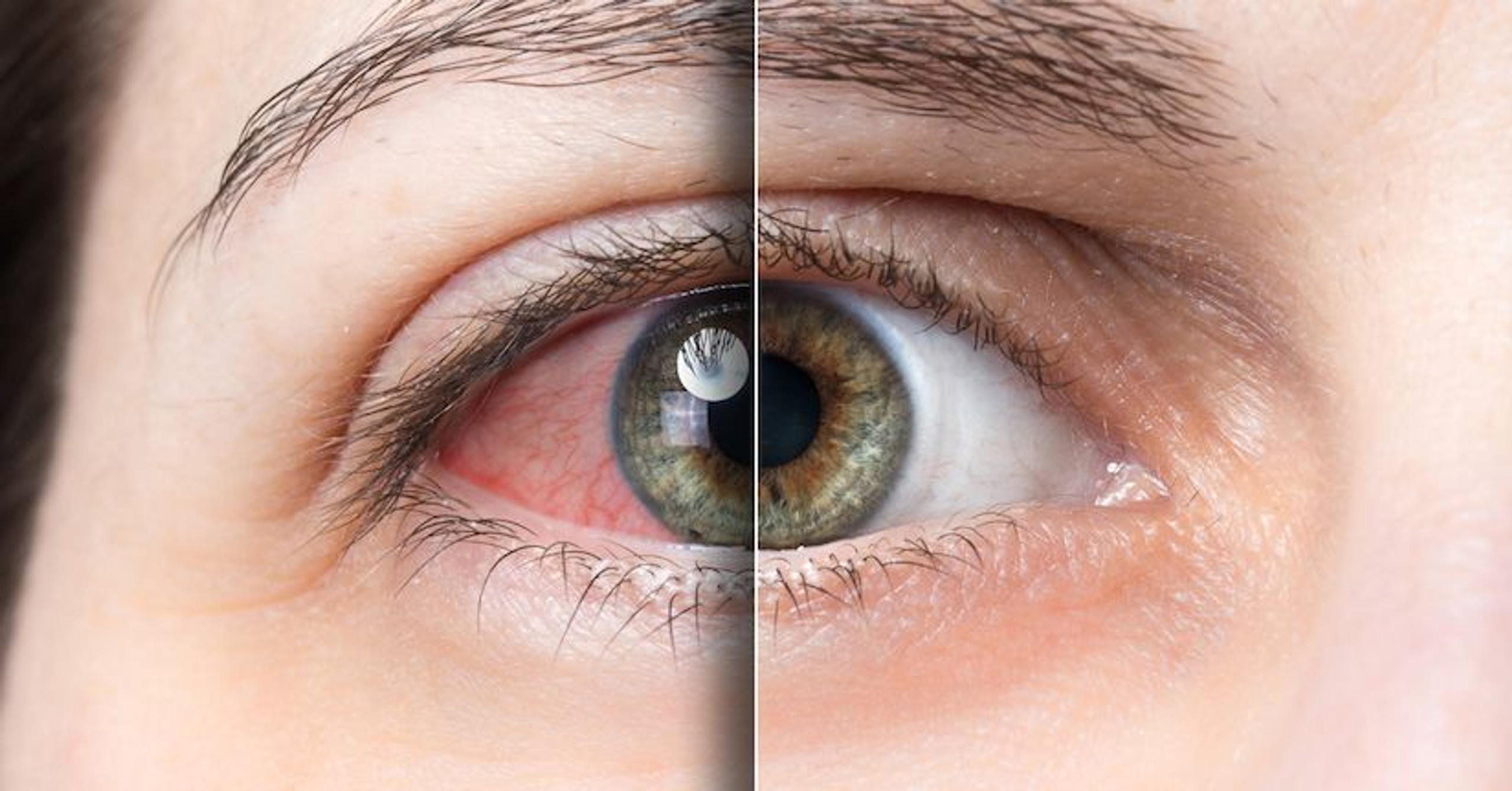 Dry Eye A Leading Cause of Light Sensitivity TheraSpecs