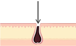 Hair retracting below the skin after shaving