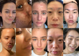 5 POWERFUL SKIN TRANSFORMATIONS