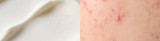 SUMMER ACNE 101