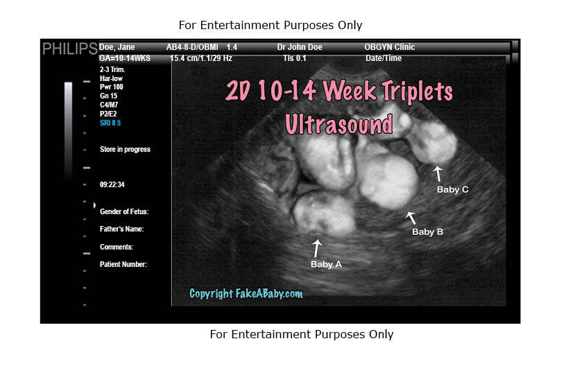 triplets sonogram