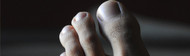 The Remarkable Link Between Ingrown Toenails and Hyperhidrosis