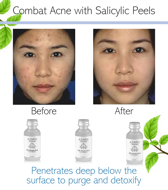 Remove Acne Scars with At-Home Chemical Peels