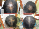 Central Centrifugal Cicatricial Alopecia (CCCA). What is CCCA?