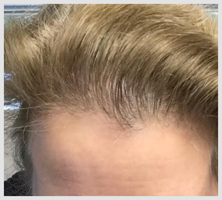 before/after Hair Loss pictures for men and women