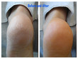 Footlogix Very Dry Skin Formula 3 4.23 oz – Foot Moisturizing Mousse for Very Dry Skin