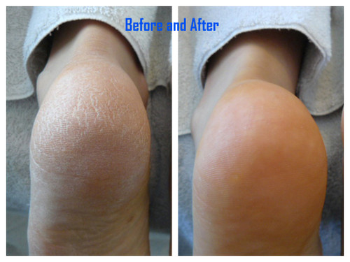 Footlogix Very Dry Skin Formula