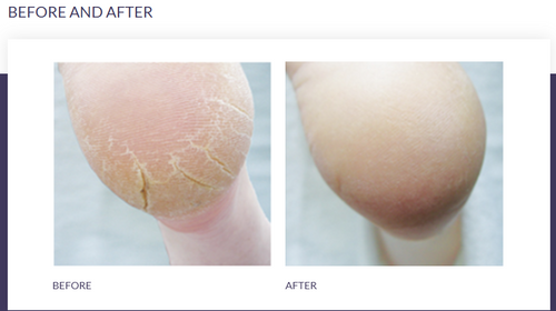 Footlogix Cracked Heel Formula – Urea Foot Mousse for Dry, Callused Cracked Heels