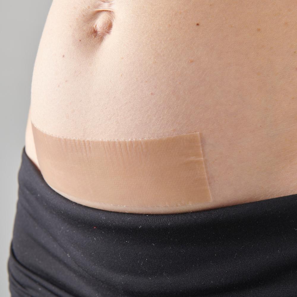 myscar The Original Caesarean Silicone Strips