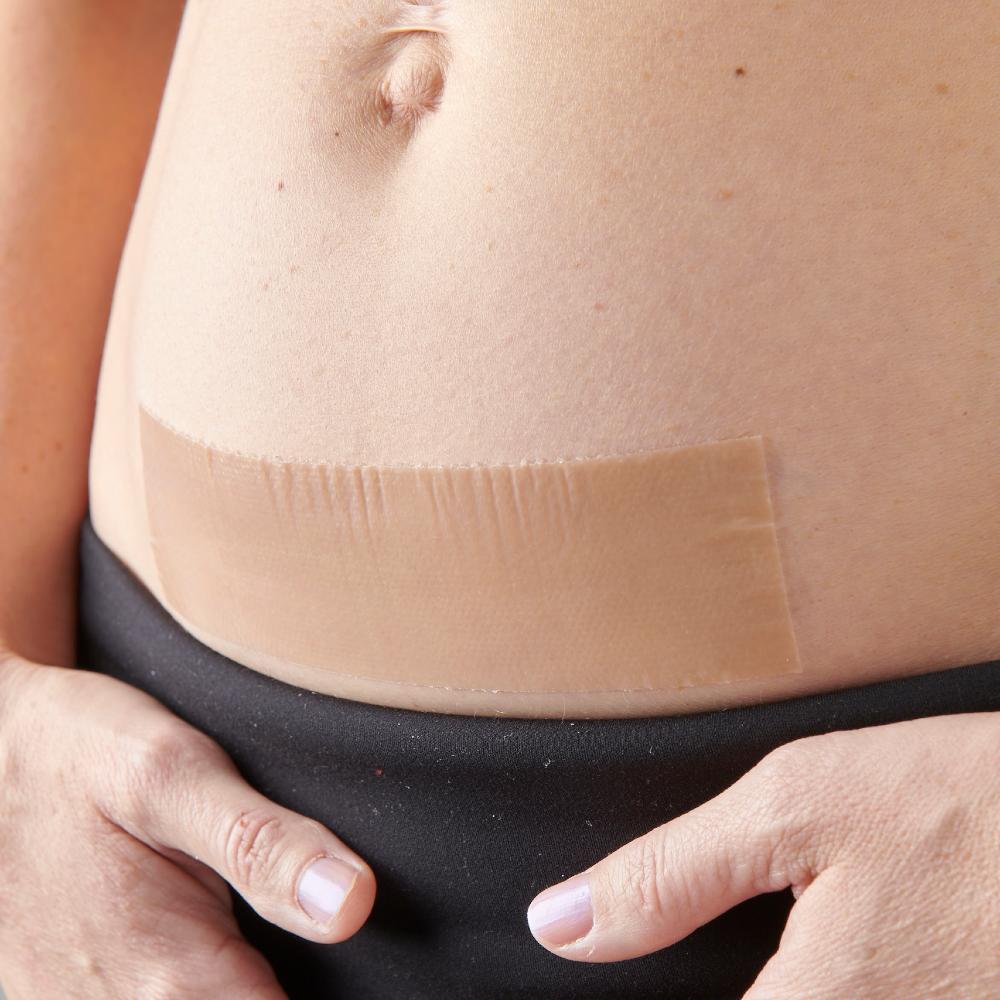 myscar The Original Caesarean Silicone Strips