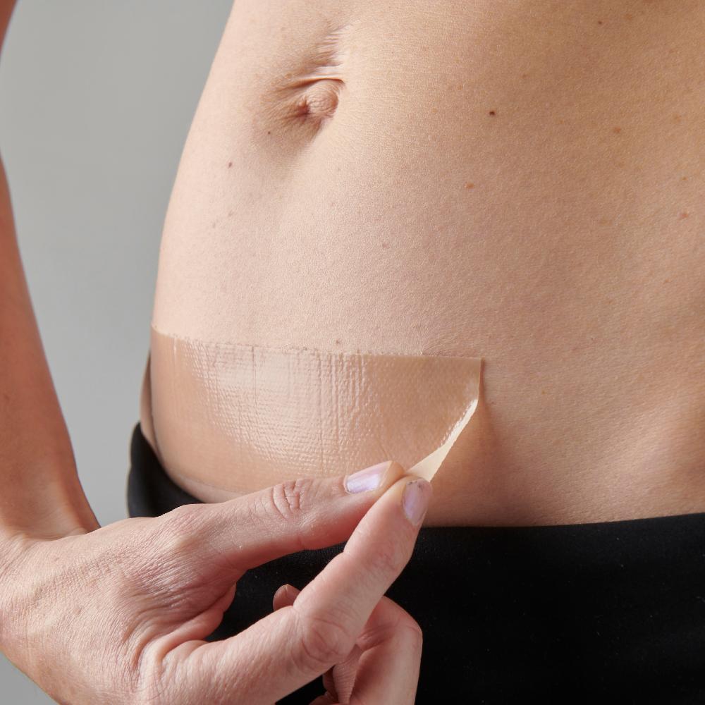 myscar The Original Caesarean Silicone Strips