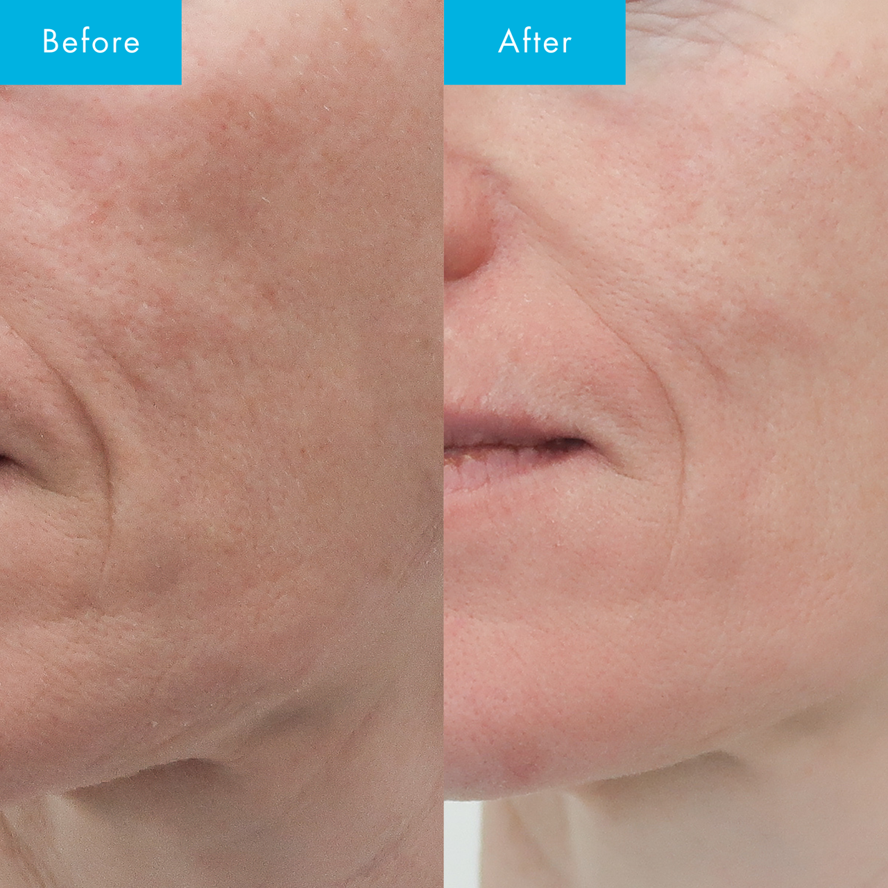 Niacinamide Ultra 5 Serum