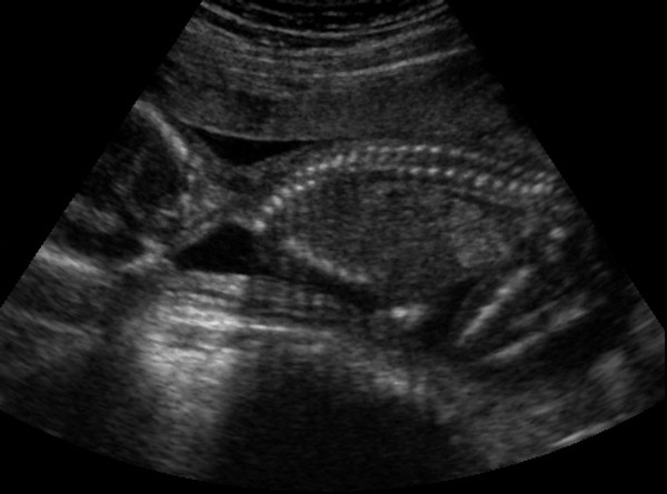 "Prince" Or "Princess" Gender  Ultrasound Determination Reveal Sonogram