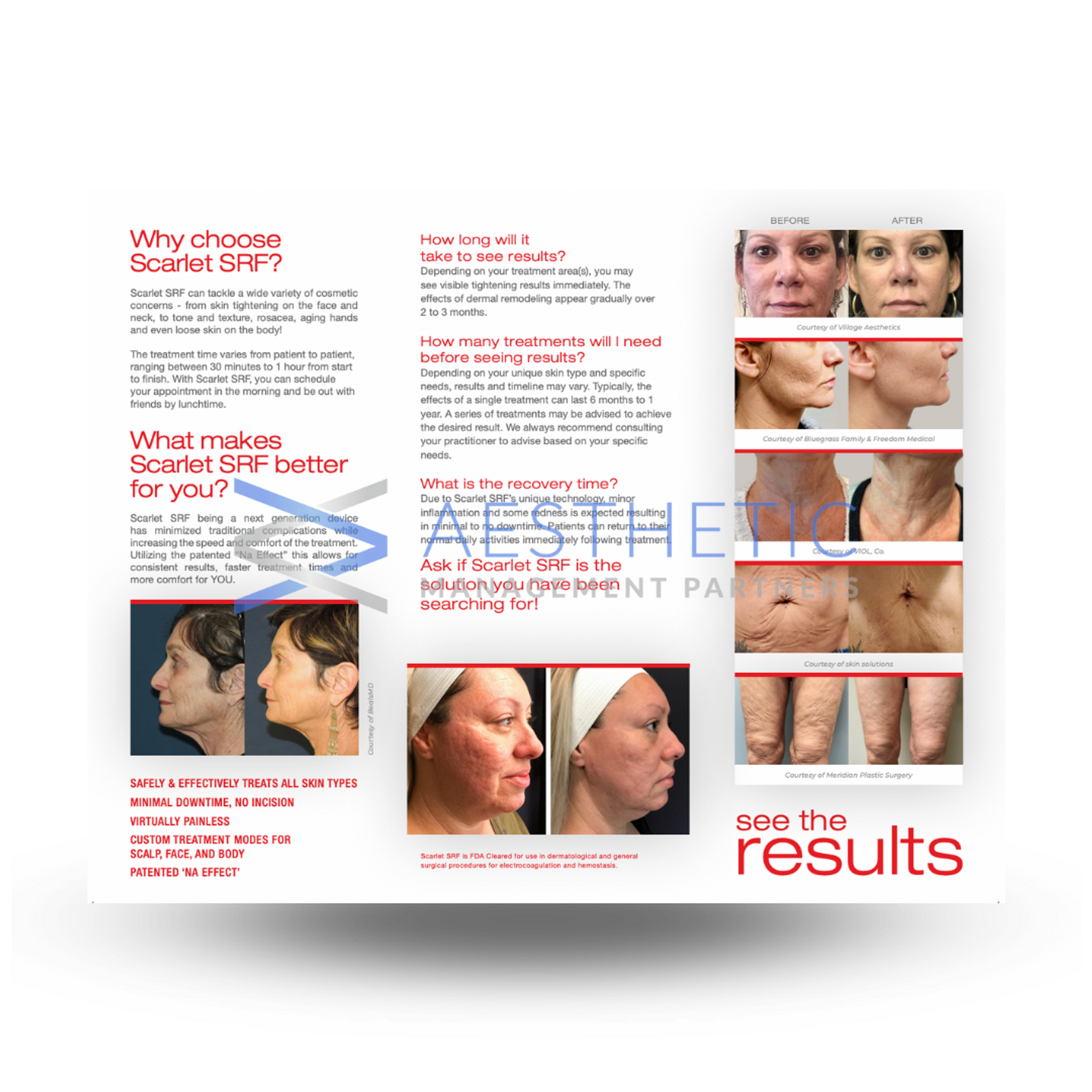 Scarlet SRF Trifold Patient Facing Brochure v2021 | Interior