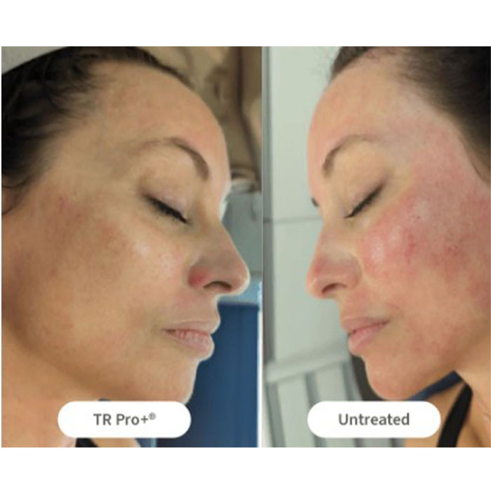 Tr Pro Tissue Repair TR Pro+ - Vivo Hair Salon and Skin Clinic