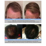 Avante Hair Restoration Serum Spray Results