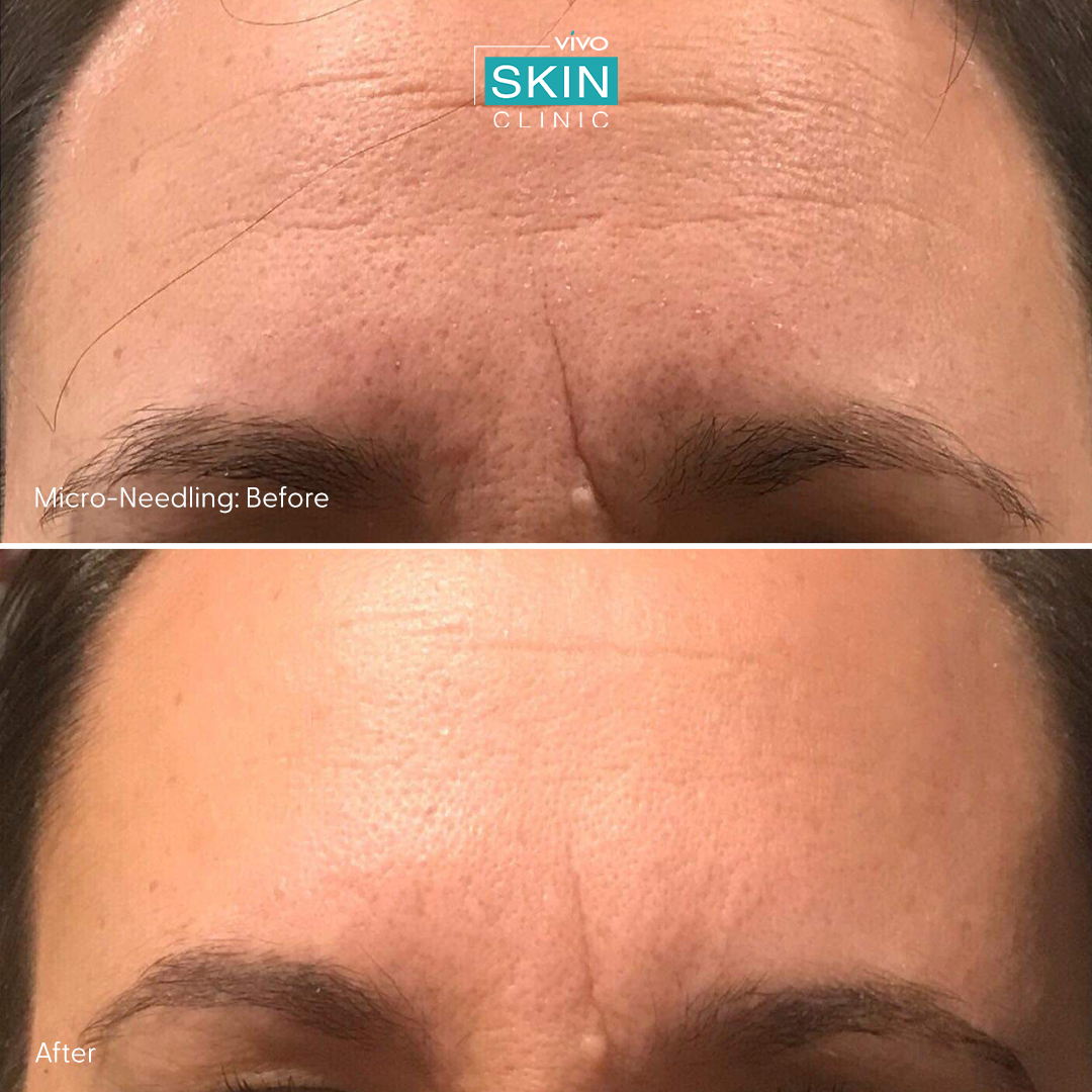 Vivo Micro-Needling: Before & After