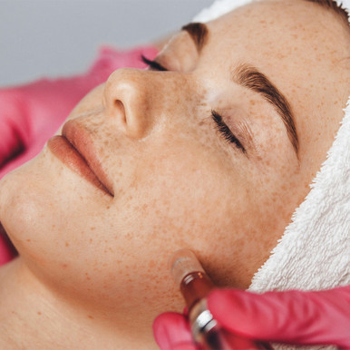 Micro-Needling