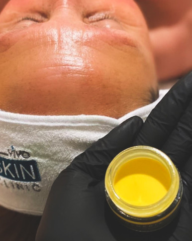 Retinol Peel Treatment