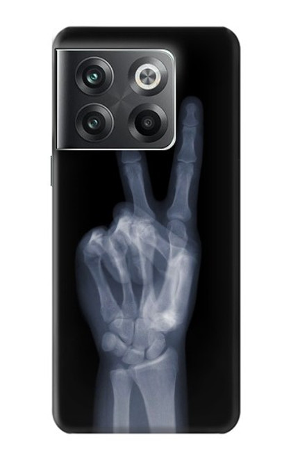 S3101 X-ray Peace Sign Fingers Funda Carcasa Case para OnePlus Ace Pro