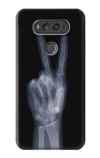 S3101 X-ray Peace Sign Fingers Funda Carcasa Case para LG V20