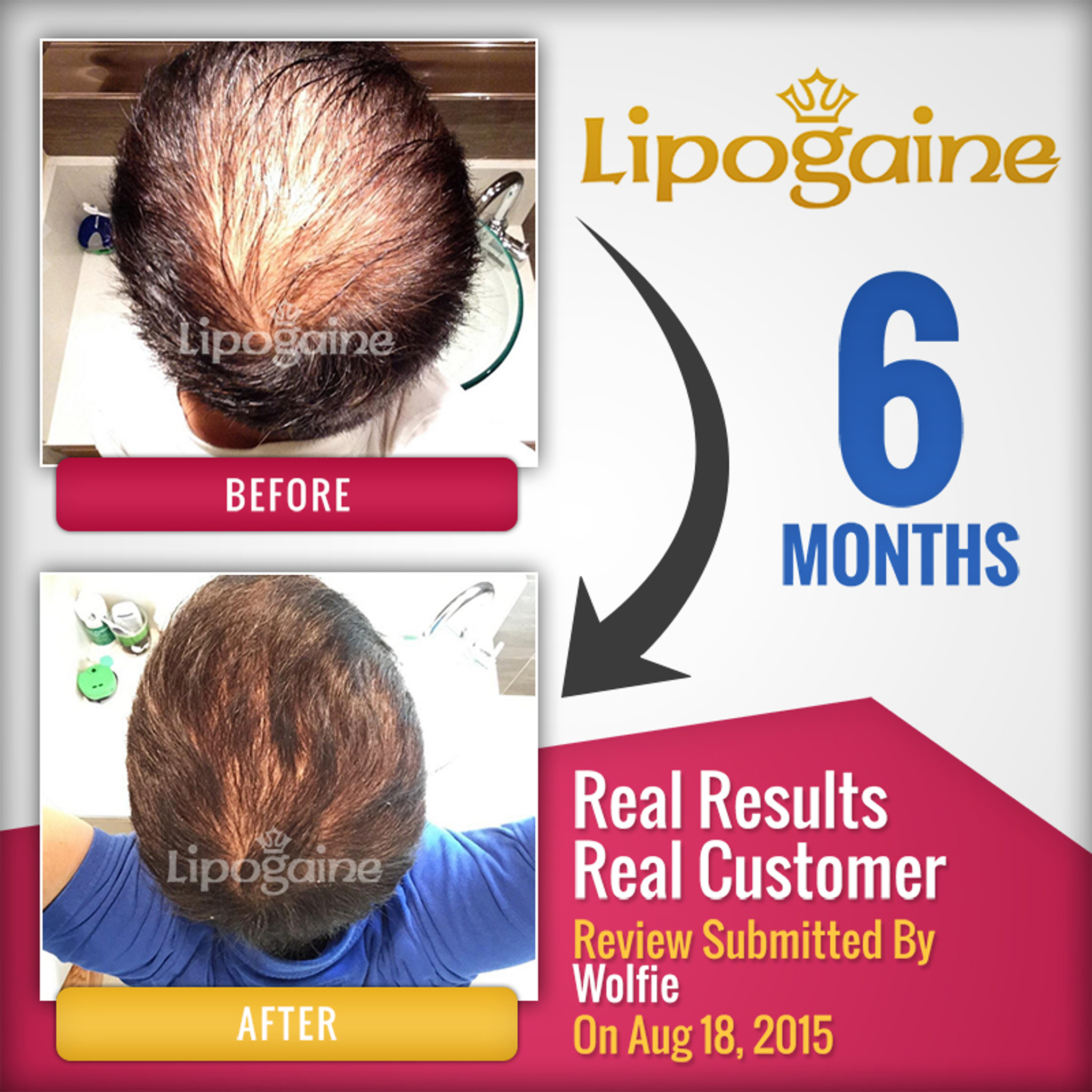 Lipogaine for men | Best Hair Loss Product