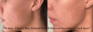 Is Cacao Bella™ Good for Acne-Prone Skin? Here’s What the Science Says