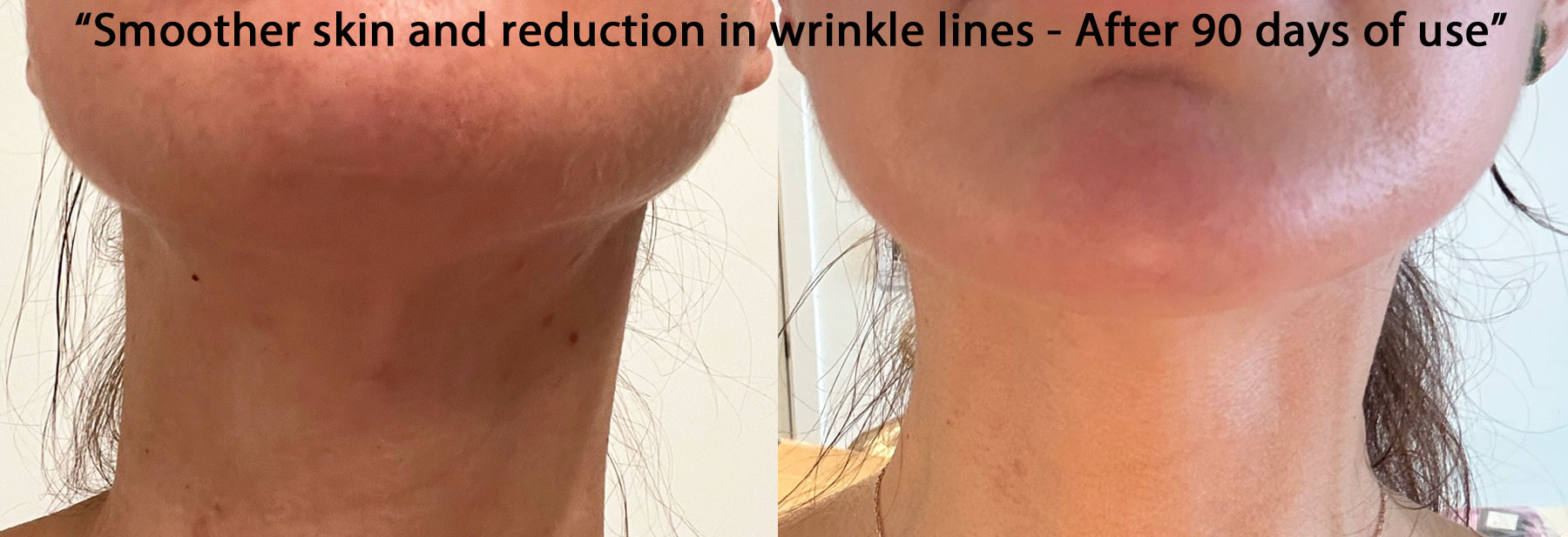 Astaxanthin vs. Hyaluronic Acid: Which Delivers Better Long-Term Skin  Health?