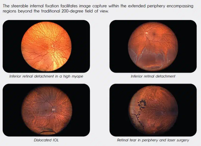 Cellview WRI-1 Retinal Imager Package
