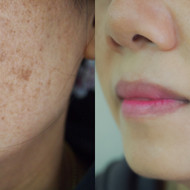 Hyperpigmentation & Melasma