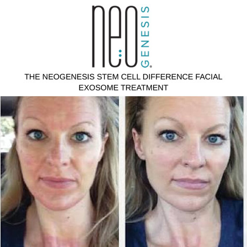 NeoGenesis Stem Cell Exosome Facial Treatment