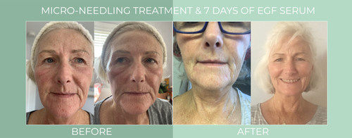 egf serum before after