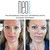 NeoGenesis Stem Cell Exosome Facial Treatment