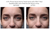 JoliPro IPL Photofacial Laser Home Device Results
