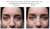 JoliPro IPL Photofacial Laser Home Device Results